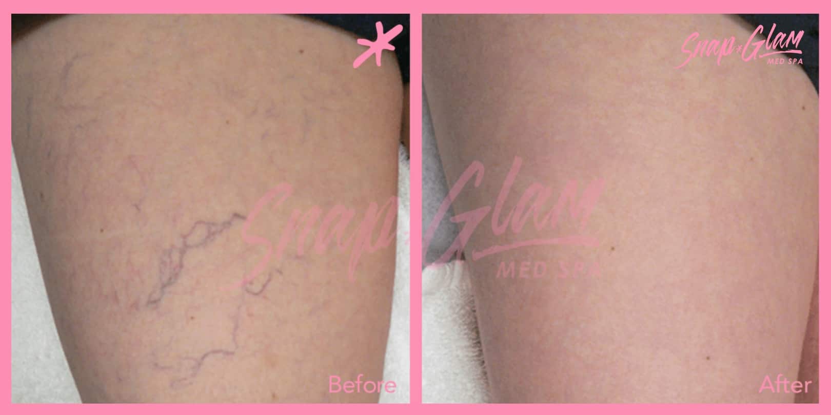Hip-injections-Before-afters-4-min
