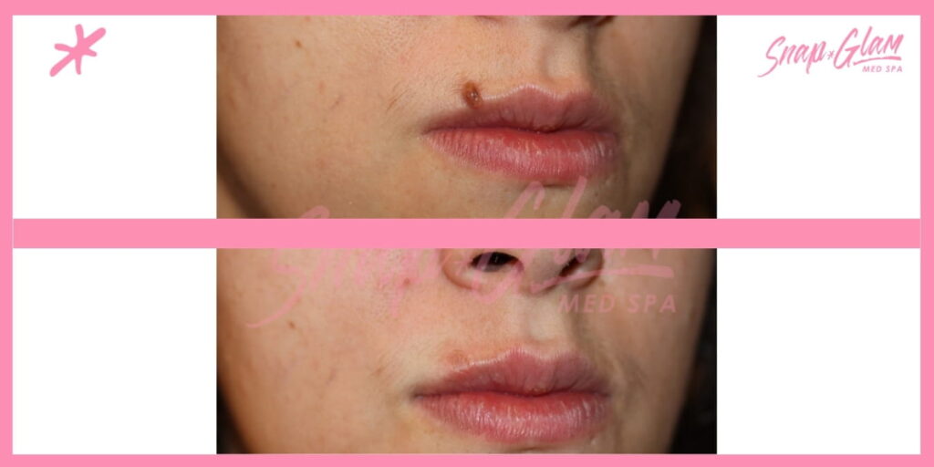 mole removal treatment before and after results