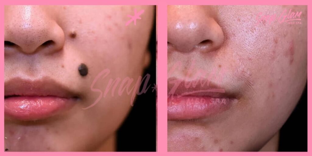 mole removal treatment before and after results