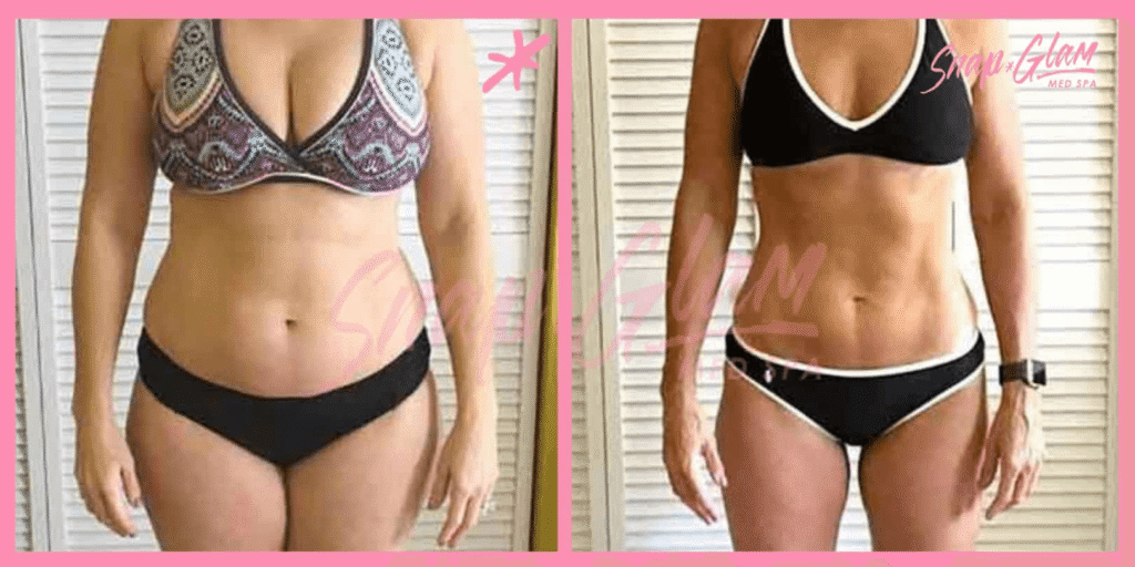 Snap Glam Weight Loss Treatment before and after result