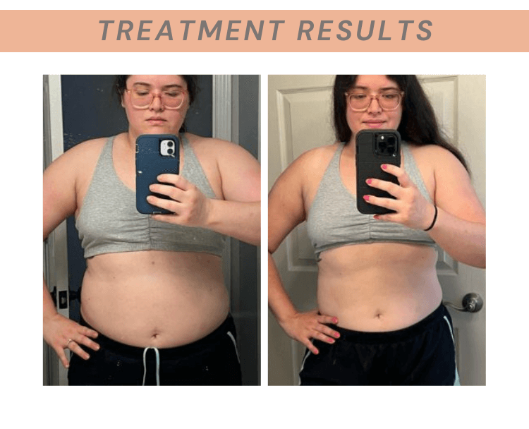 Weight Loss treatment results selfie mirror photo