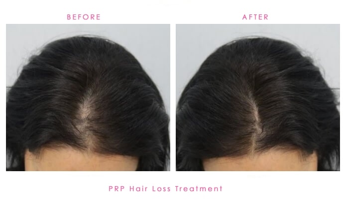PRP-Hair-Loss-before-after-1
