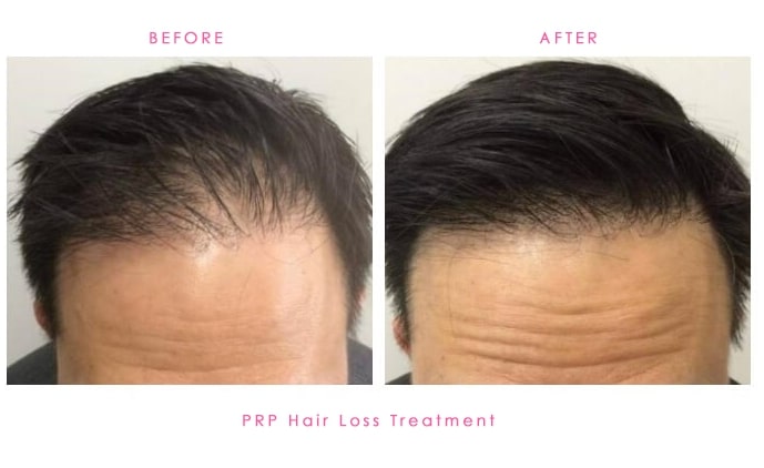PRP-Hair-Loss-before-after-3