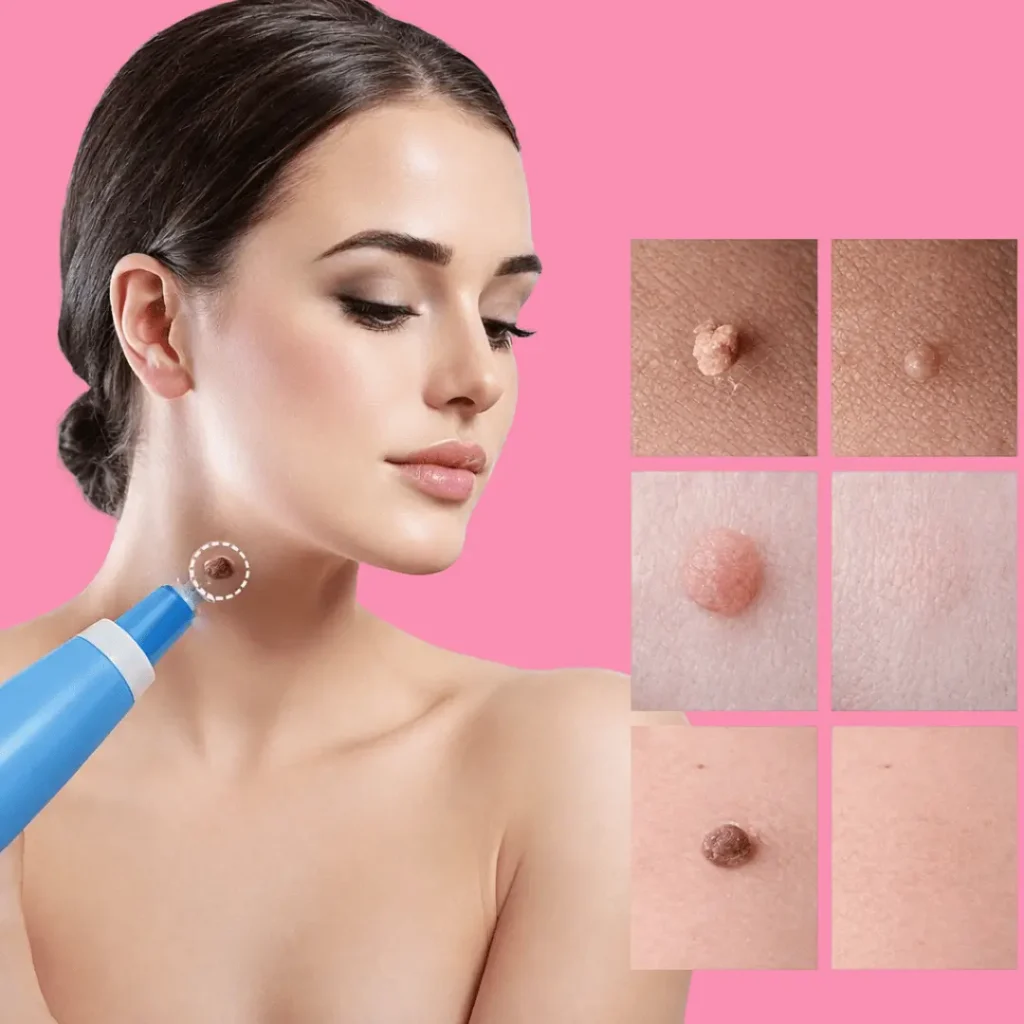 Skin-tags-removal-treatment-results - before and after results showing
